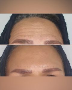 مزایا و معایب نخ لیفت صورت 