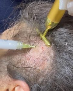 مزوتراپی مو چیست ؟ میزان تاثیر آن بر مو ، مکانیزم عمل – تعداد جلسات لازم برای مزوتراپی مو – مدت زمان تاثیرگذاری و ماندگاری