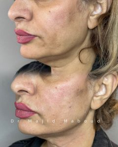 مزایا و معایب لیفت صورت با نخ