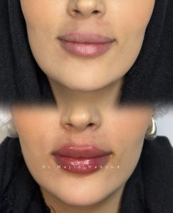 تفاوت فیلر لب با ژل چیست | مقایسه آنها با هم 