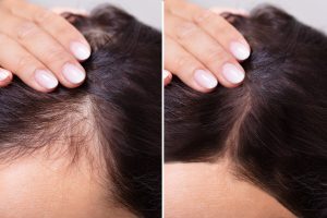 مزوتراپی مو چیست و چقدر تاثیر دارد 