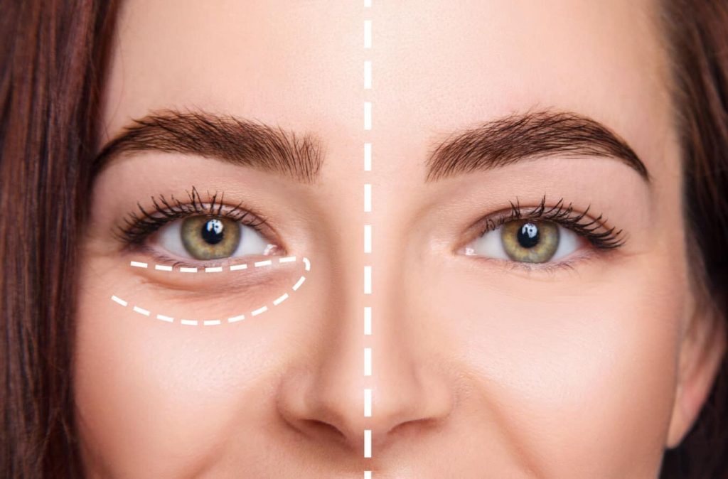 عوارض فیلر چشم – آیا فیلرزیر چشم باعث کوچک شدن چشم می شود