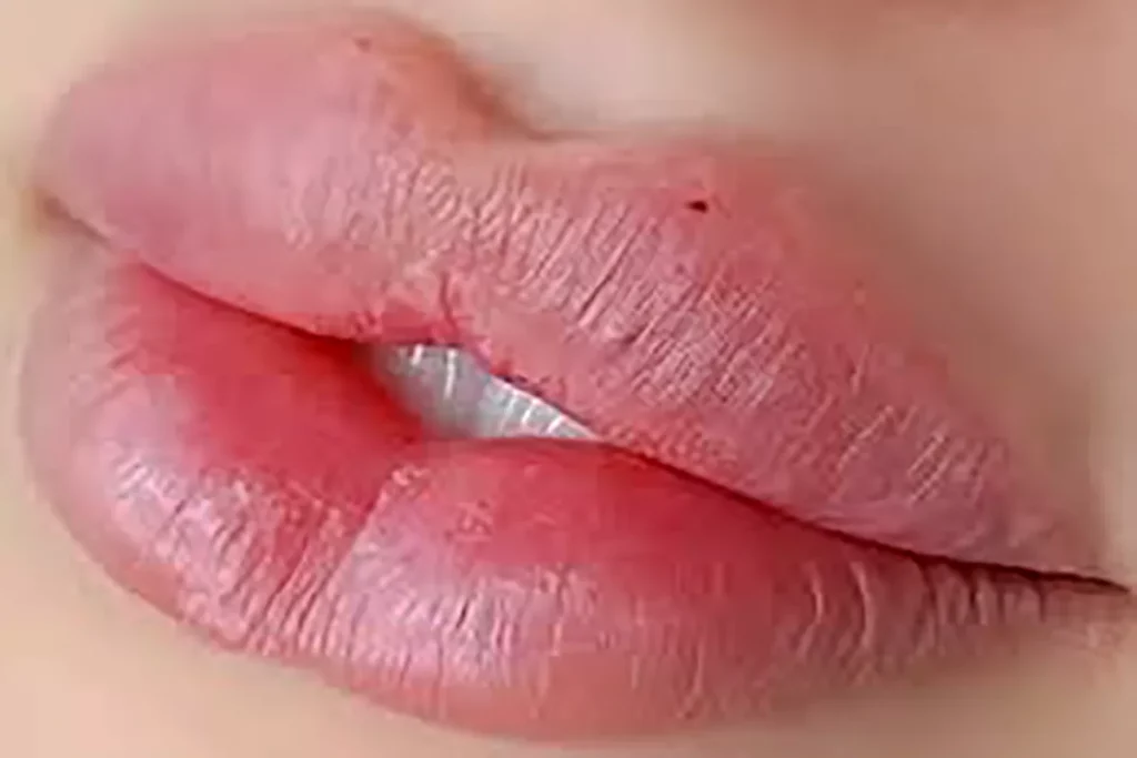 انواع مدل تزریق فیلر لب به همراه عکس های هر کدام