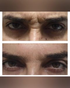 تزریق بوتاکس