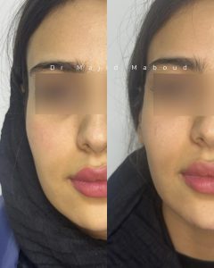 عکس قبل و بعد تزریق فیلر شقیقه