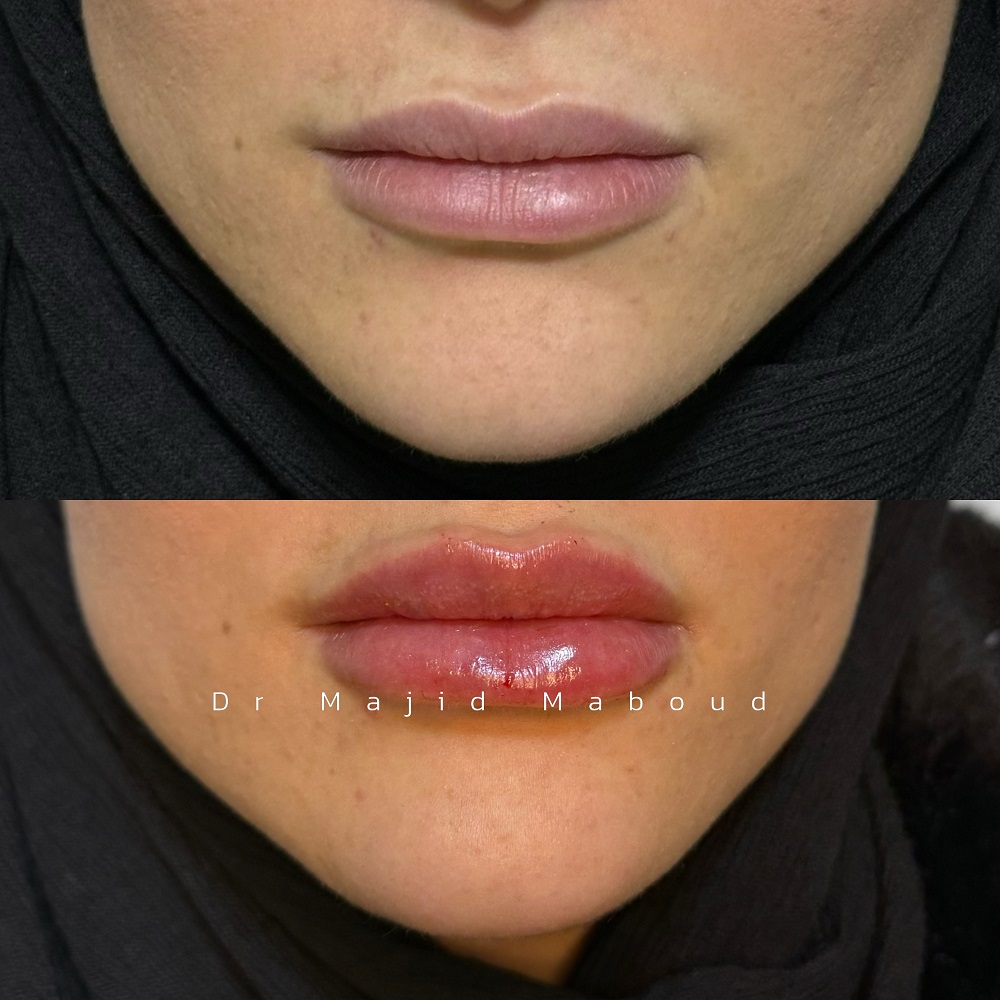 تزریق فیلر لب