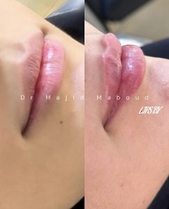 تزریق فیلر لب