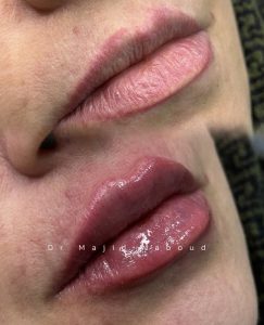تزریق فیلر لب