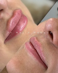 عکس قبل و بعد تزریق فیلر لب
