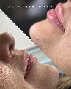 تزریق فیلر لب و چونه