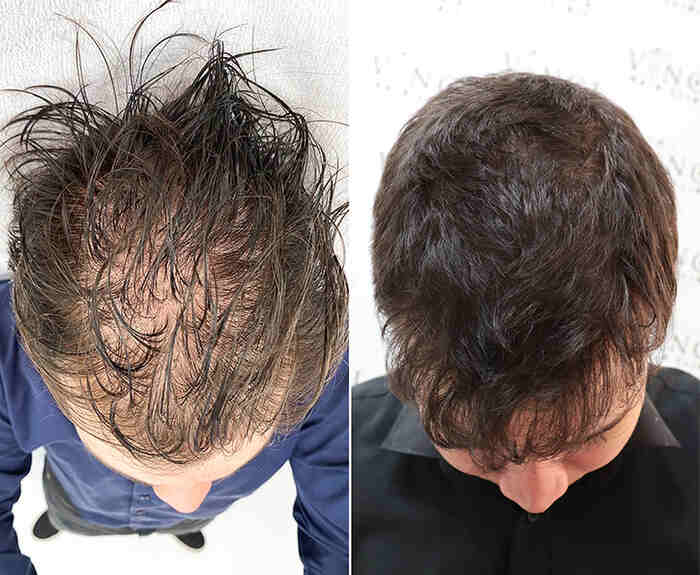 عکس قبل و بعد مزوتراپی مو