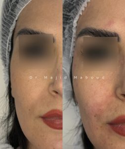 تزریق فیلر شقیقه
