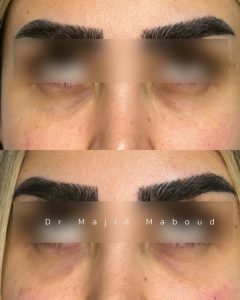تزریق فیلر زیر چشم
